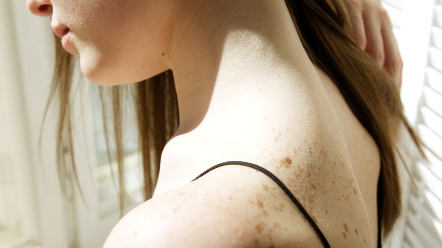 Pigmentation Removal Singapore: How much does Pigmentation Removal Cost?