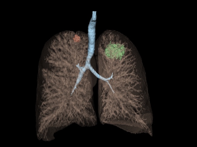 MRI Lung Tumours