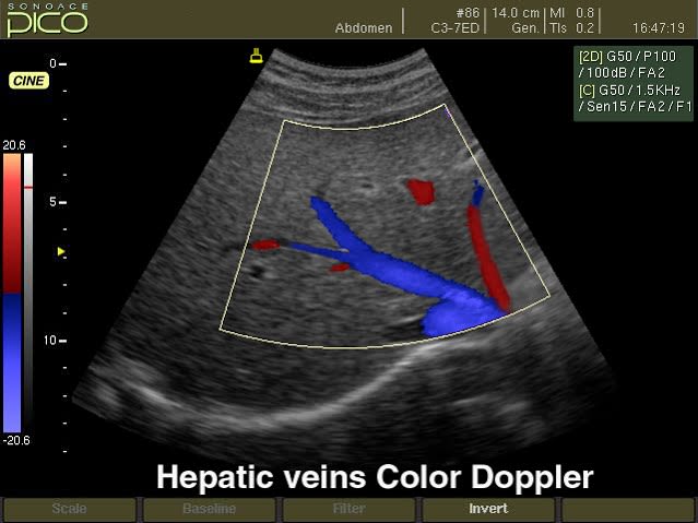 Color Doppler