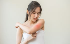 Allergie aux moustiques : causes et symptômes