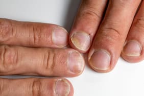 Zoom sur le Psoriasis de l'ongle ou psoriasis unguéal