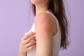 Allergies et réactions au soleil : prévention et astuces 