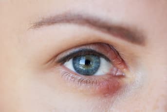 Lutter contre l'eczéma des yeux et des paupières