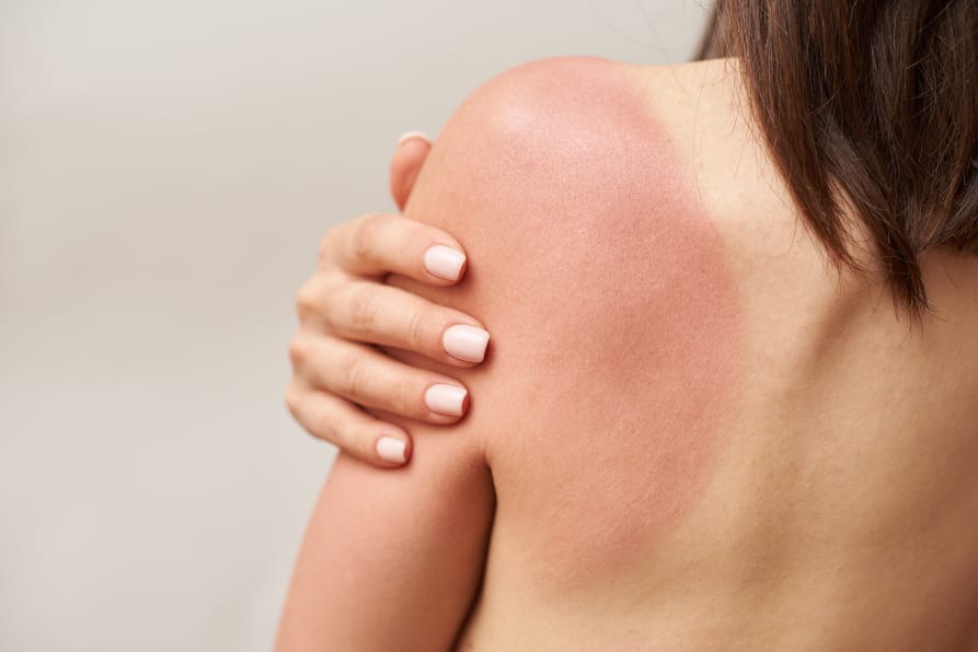 Brûlures et coups de soleil : quelles solutions naturelles ? Aroma Zone