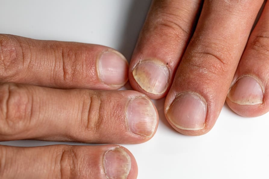 Psoriasis de l'ongle (psoriasis unguéal) : causes et traitements ...