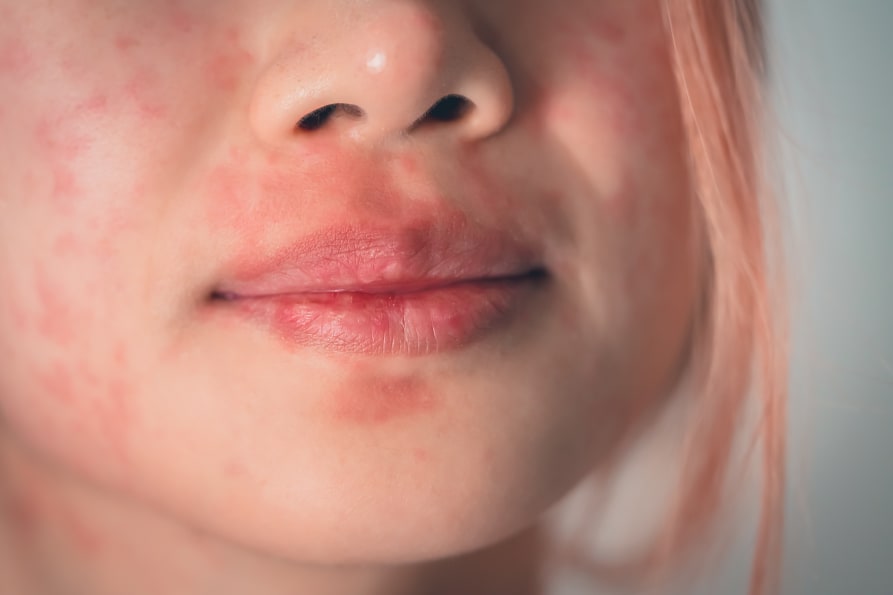 Eczéma autour de la bouche : causes et solutions naturelles ...