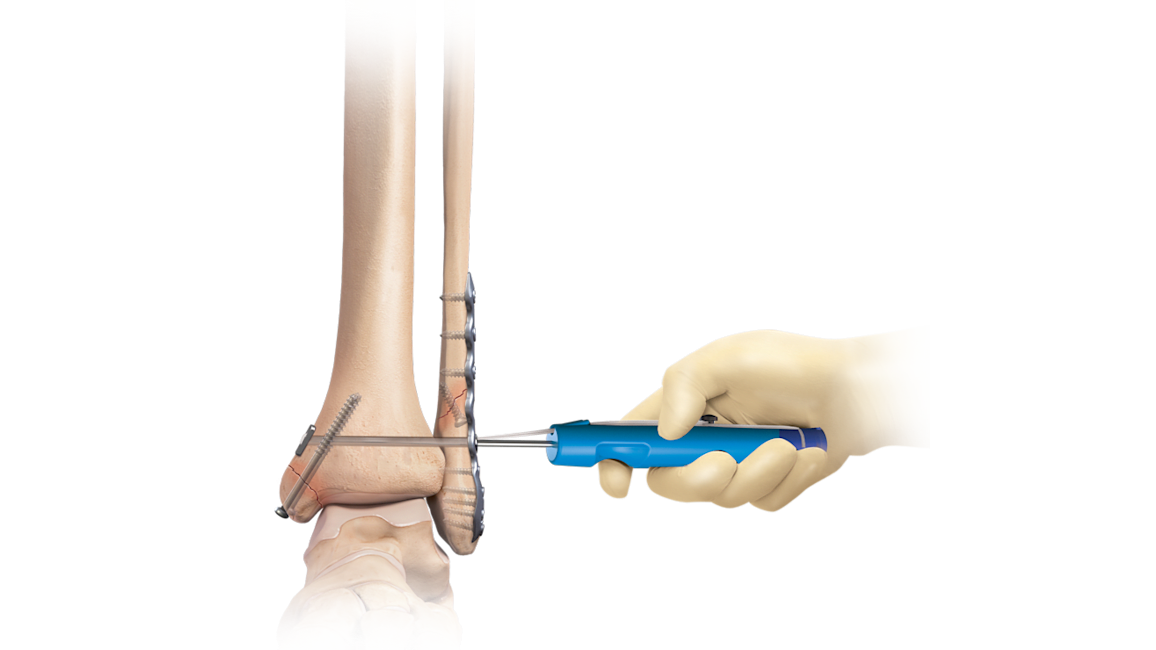 Ankle Fracture Management
 System