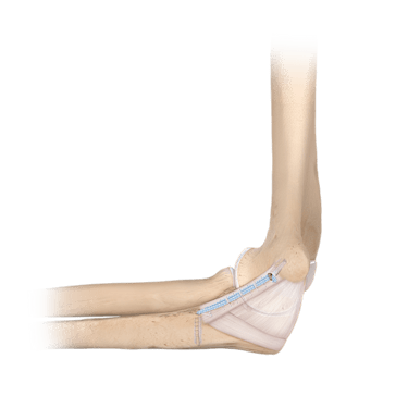 Sistema <em>Internal</em>Brace™ para LCC