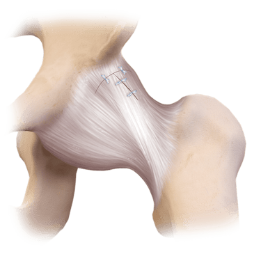 LoopLoc™ Knotless Implant