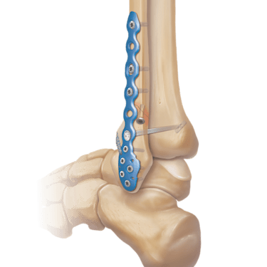 Ankle Fracture System™ aus Titan