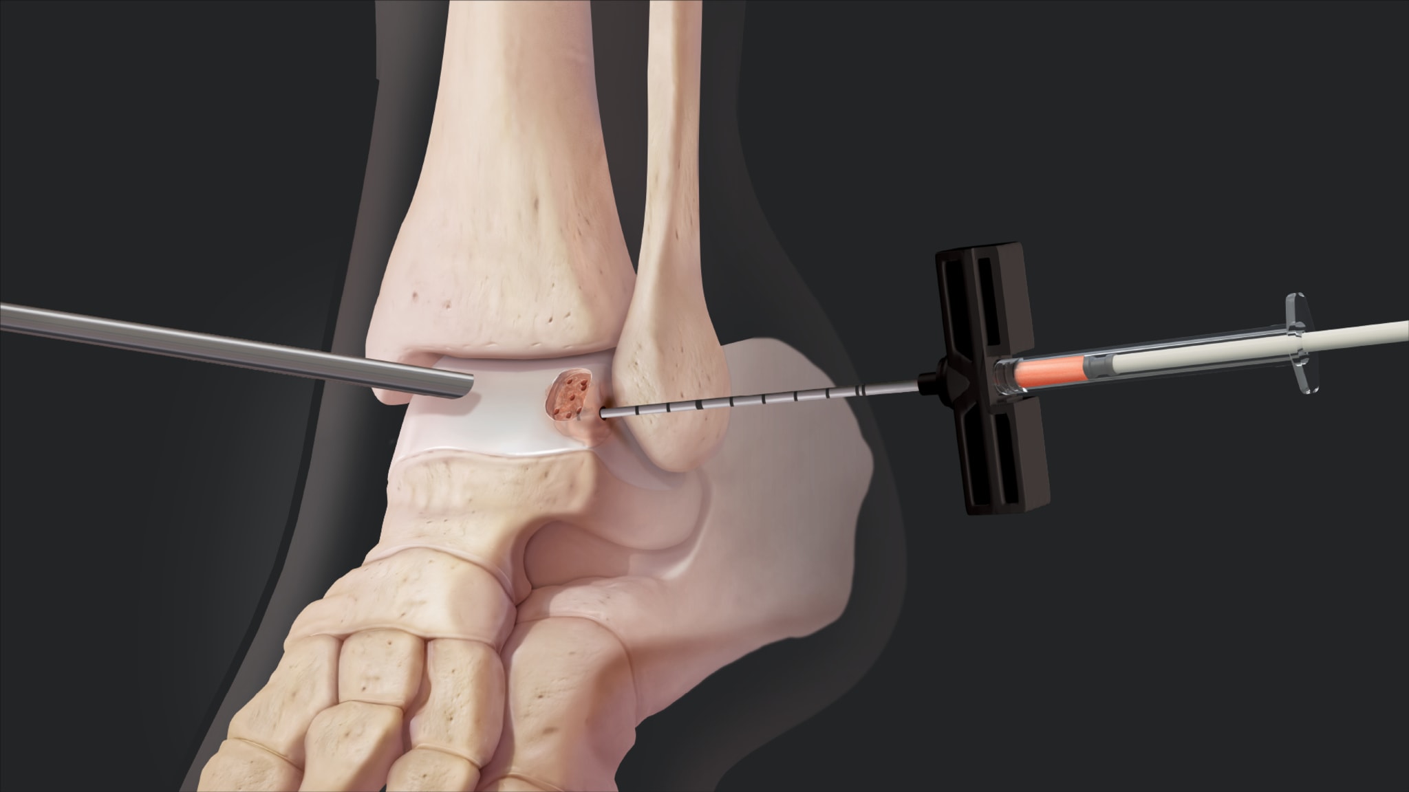 IntraOsseous BioPlasty® Technique in the Talus Using the NanoScope™ Operative Arthroscopy System