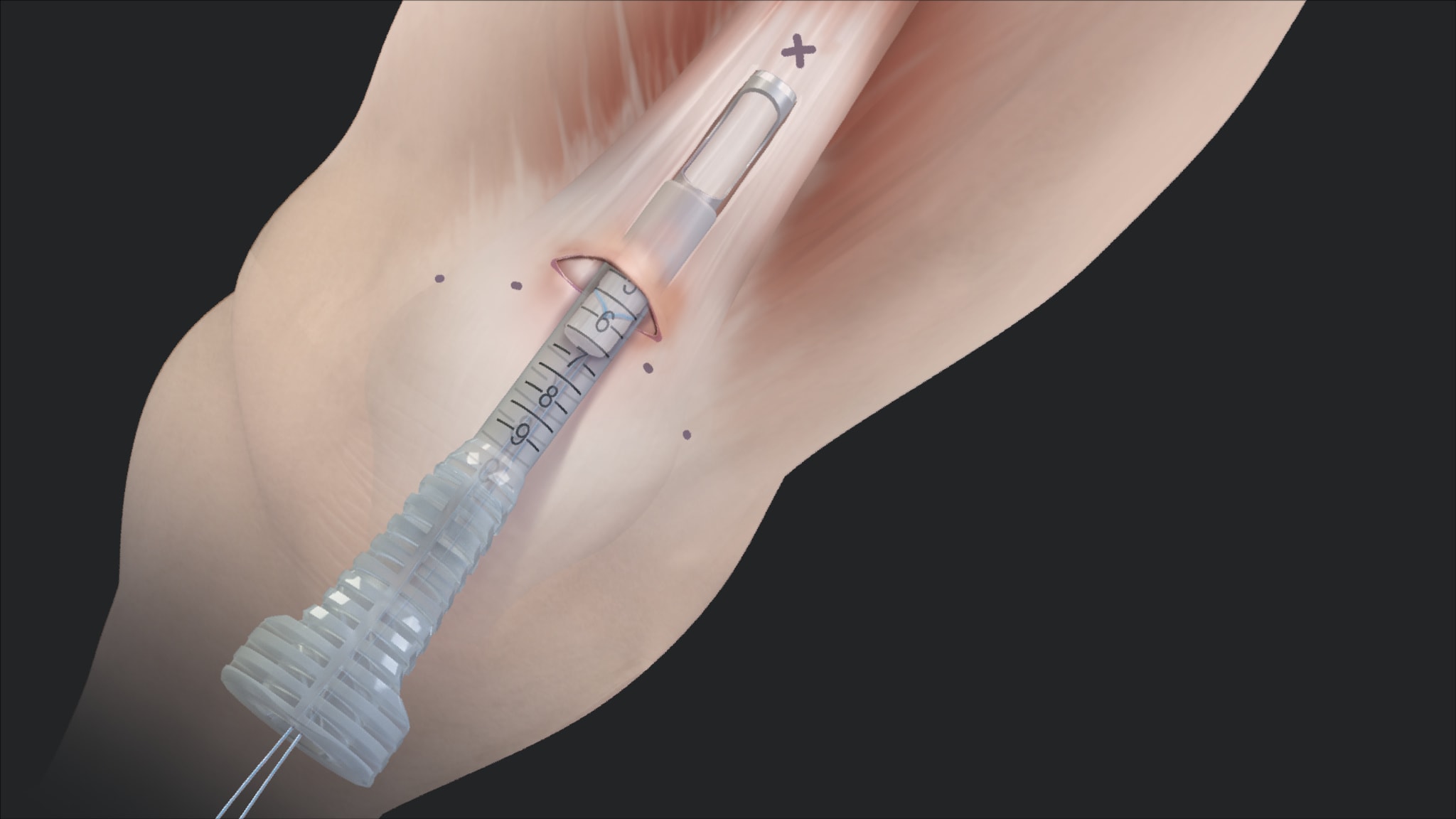 Minimally Invasive Bone Quad Tendon ACL Reconstruction Using the QuadPro™ Harvester