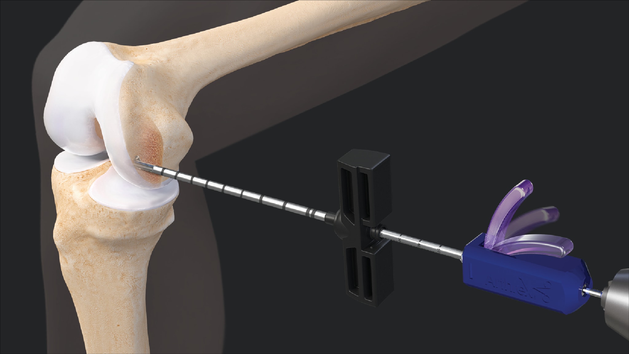 IOBP® Decompression Device