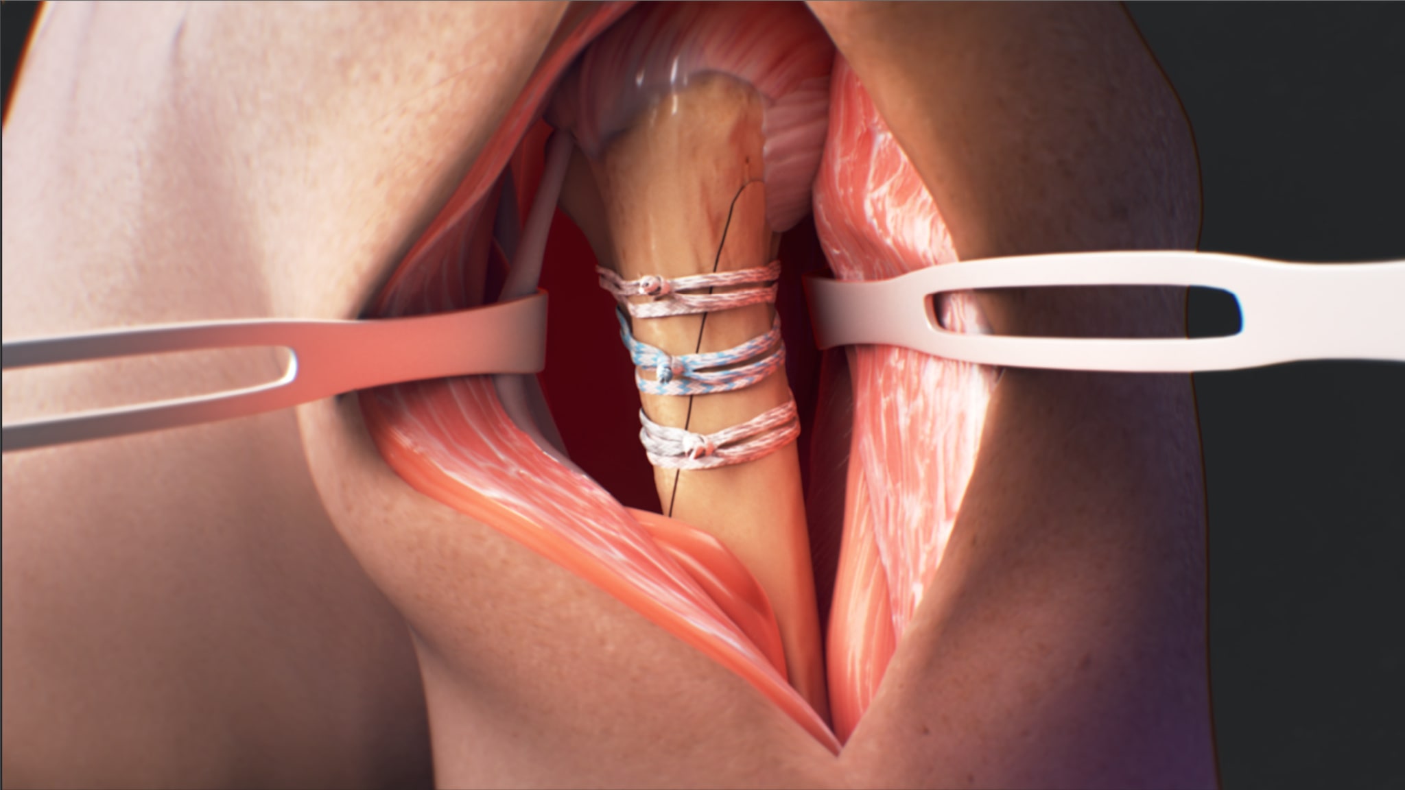 FiberTape® Cerclage System