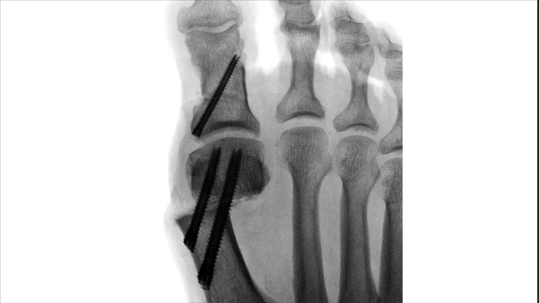 Arthrex Minimally Invasive Bunionectomy Surgical Technique