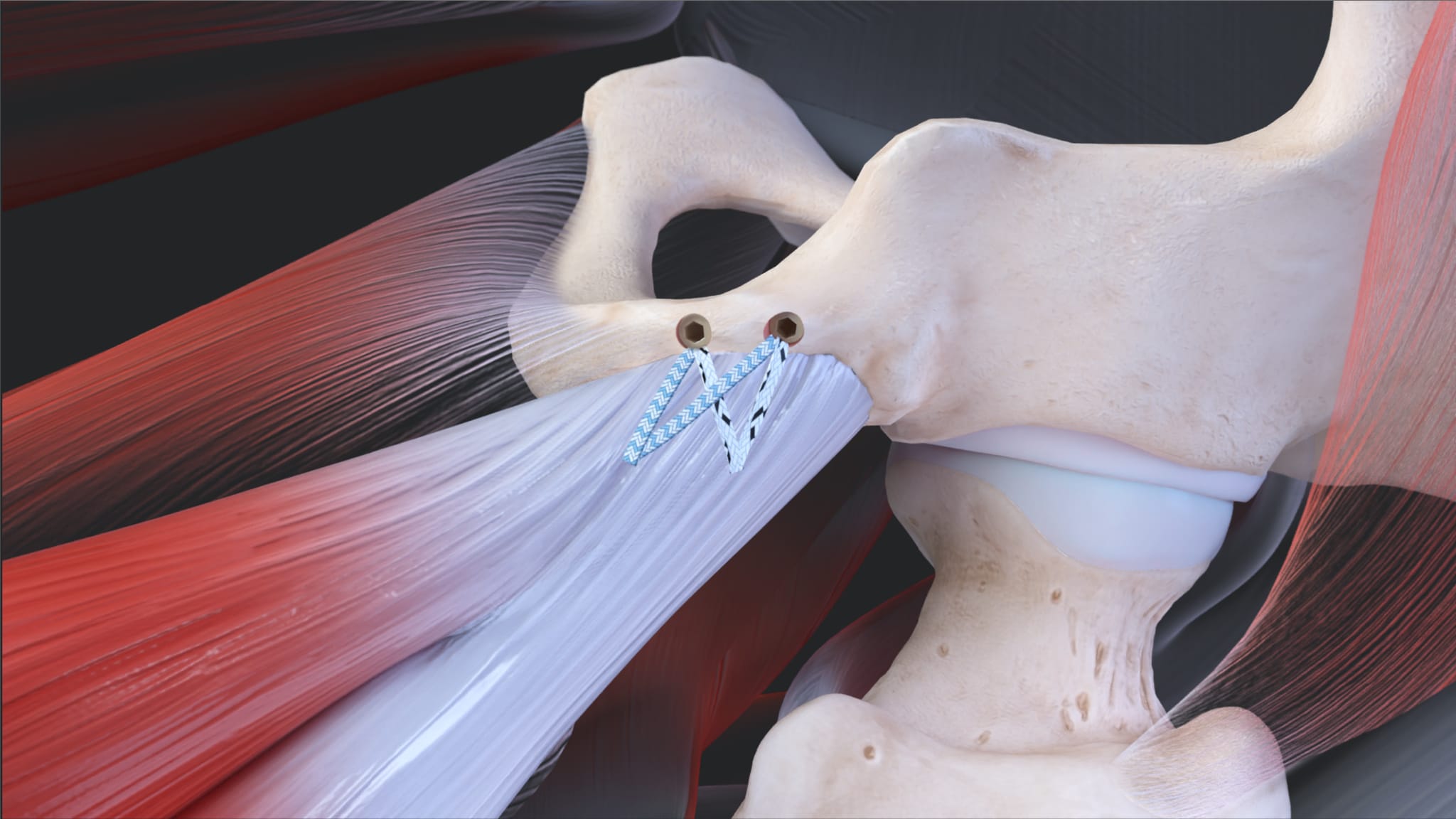 Proximal Hamstring Tendon Repair