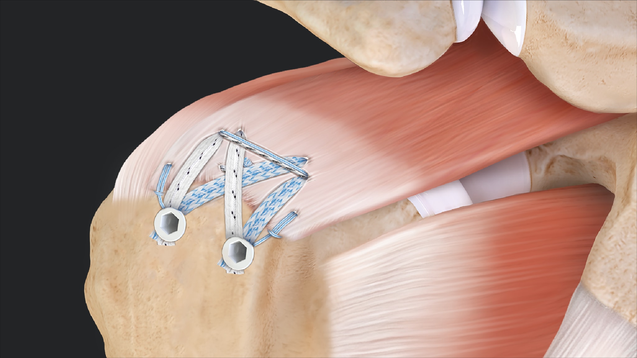 Compression SpeedBridge™ Rotator Cuff Repair