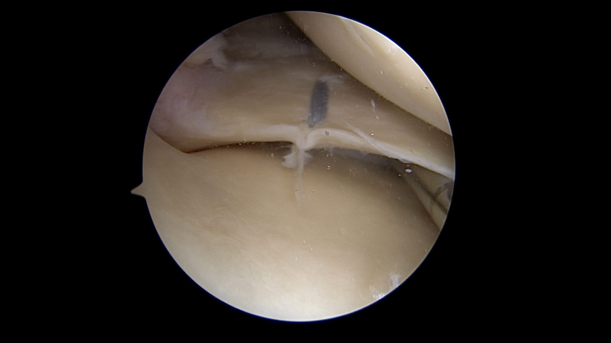 Repair of Undersurface Meniscal Tears Using the FiberStitch™ Implant