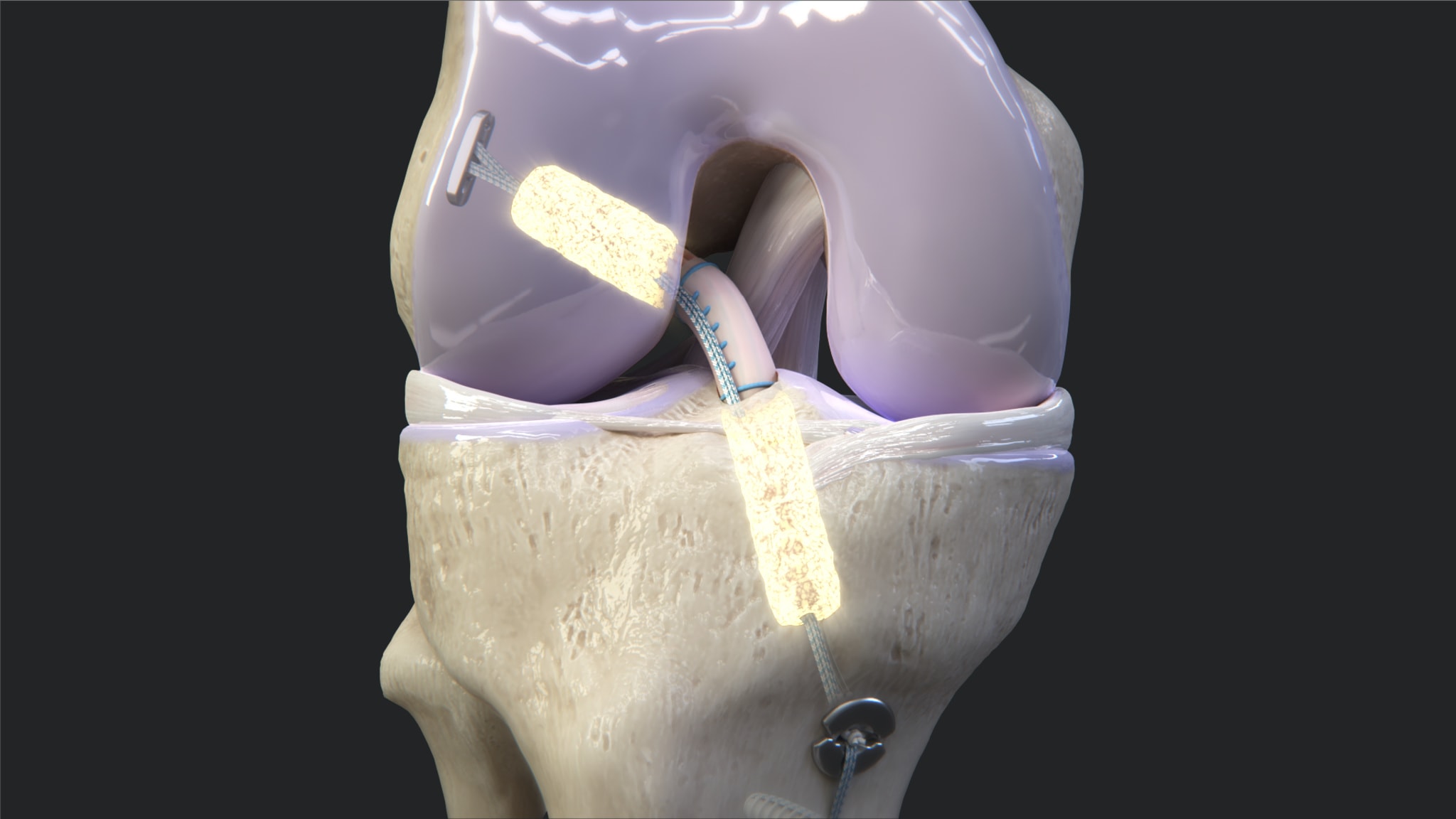 BioACL™ Technique Animation