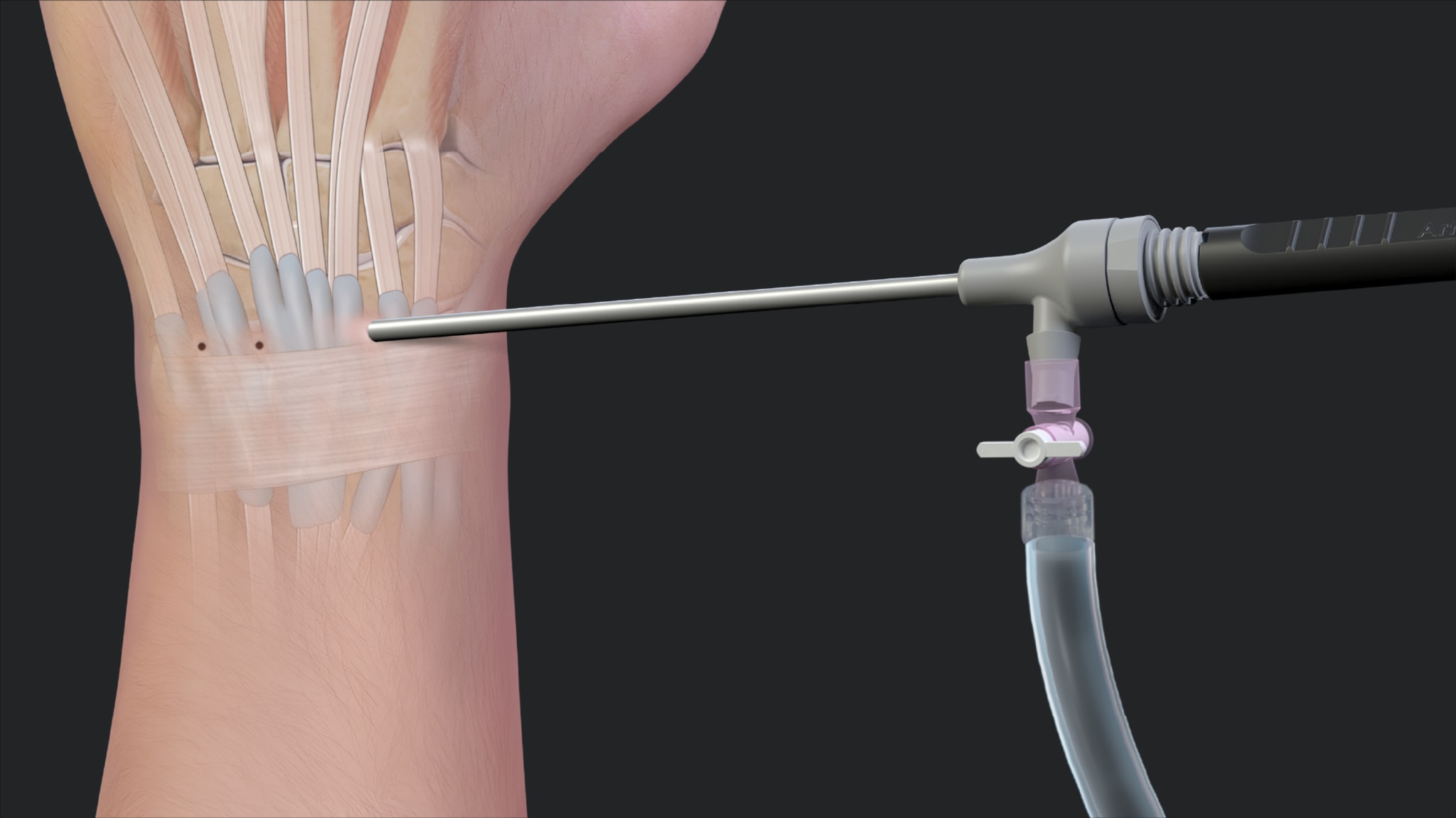 Comprehensive NanoNeedle Arthroscopy Portfolio