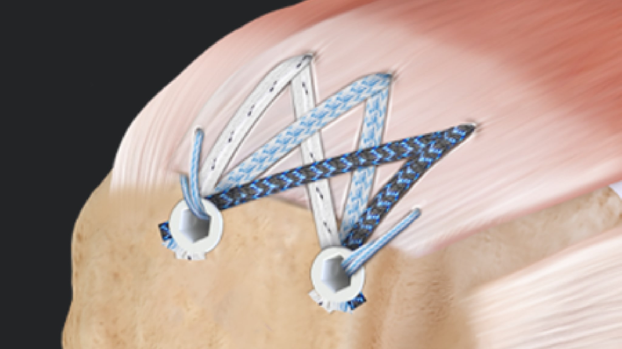 FiberTak® SpeedBridge™ RCR With 2.6 FiberTak RC Anchors for Delaminated Rotator Cuff Tears