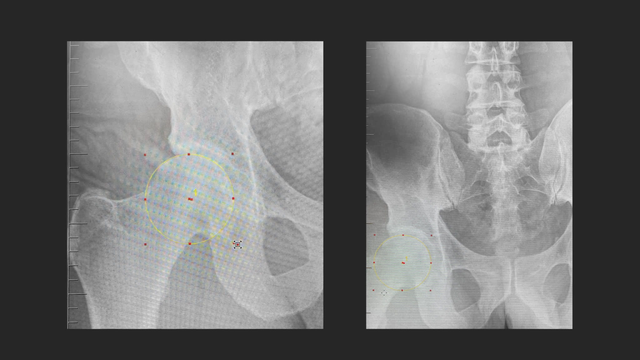 Primary Acetabular Labral Reconstruction Case Presentation