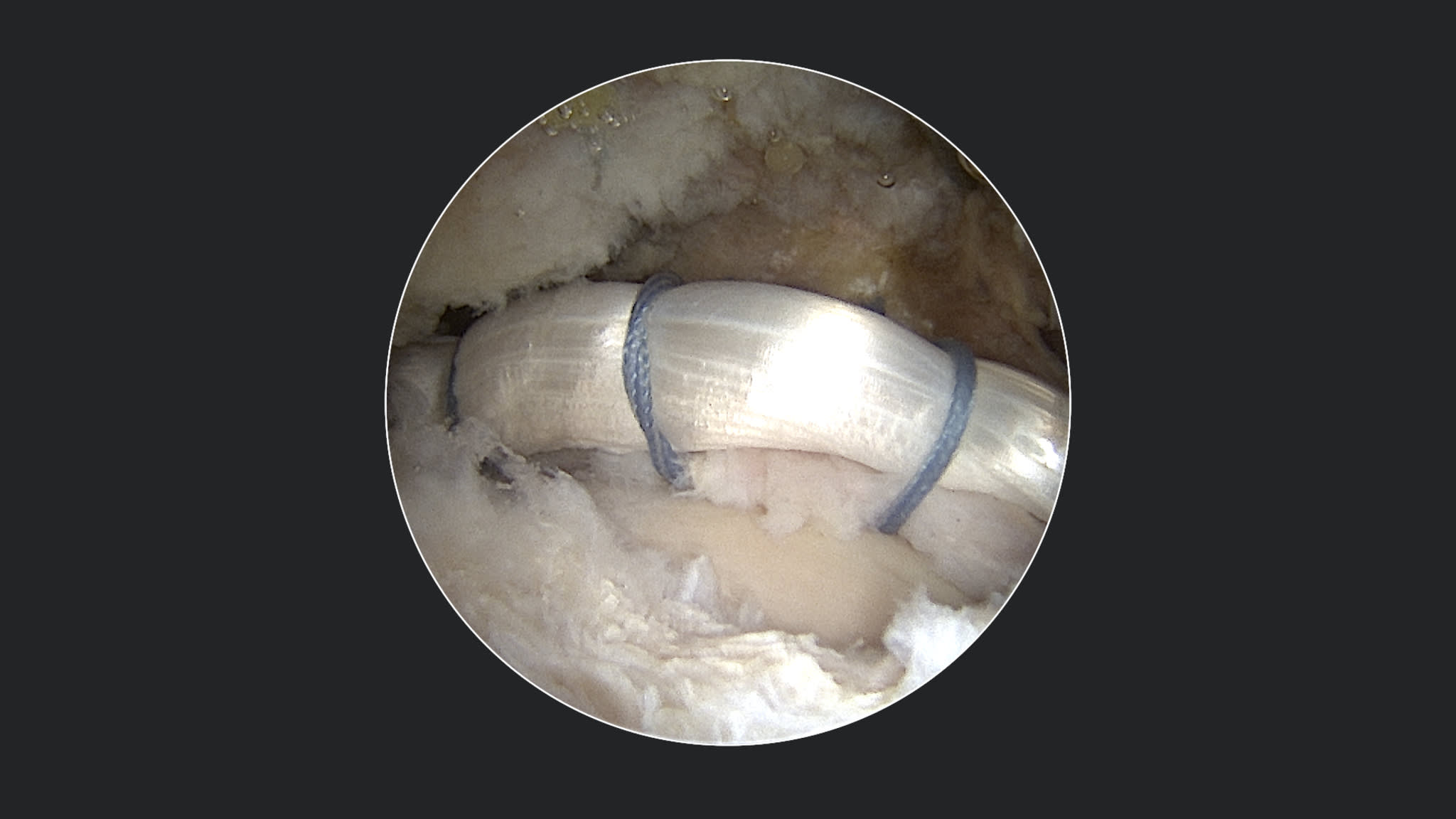 Labral Augmentation Using Knotless 1.8 Hip FiberTak® Anchors, Gen2