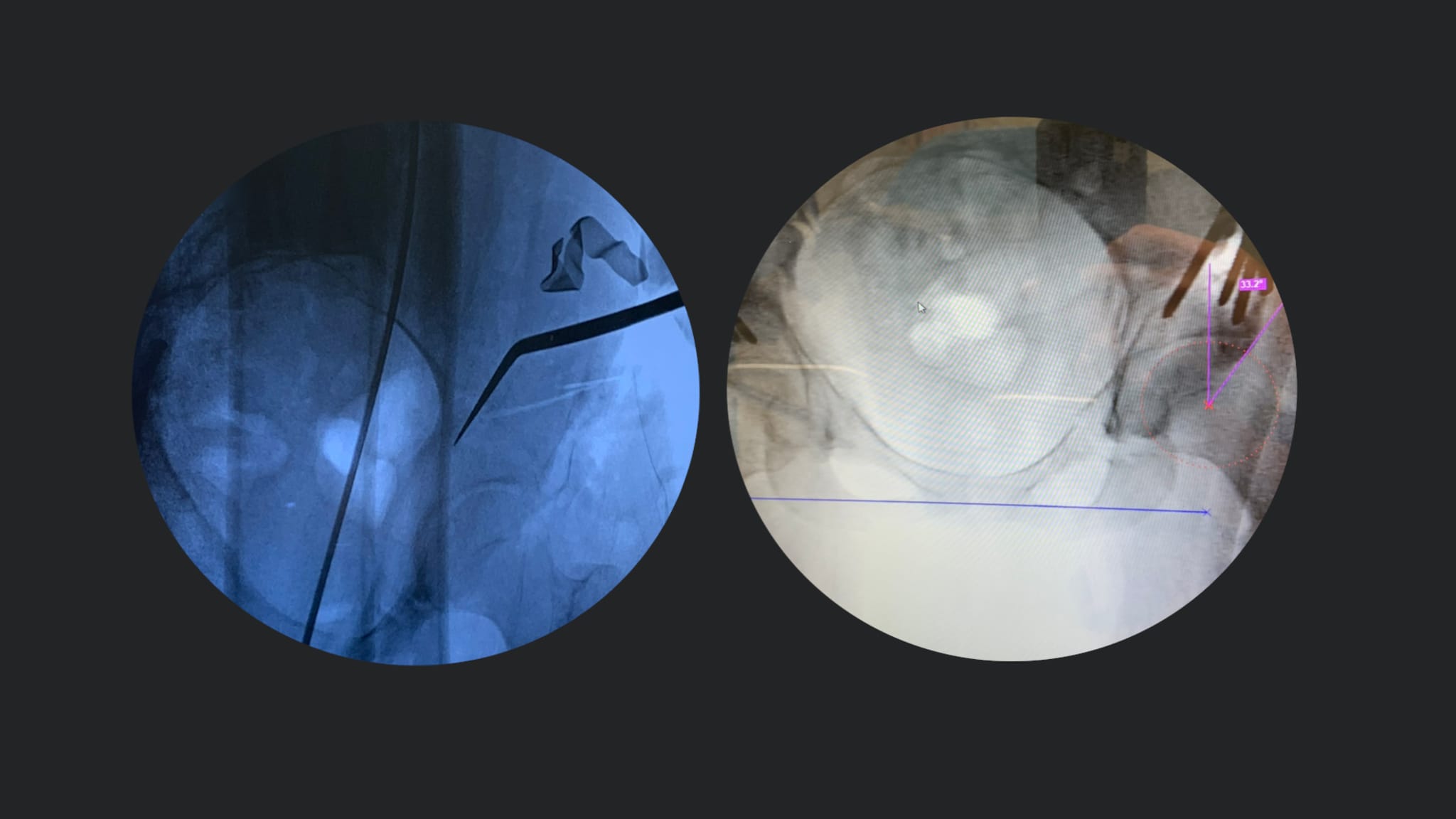 Primary Labral Repair With a Periacetabular Osteotomy