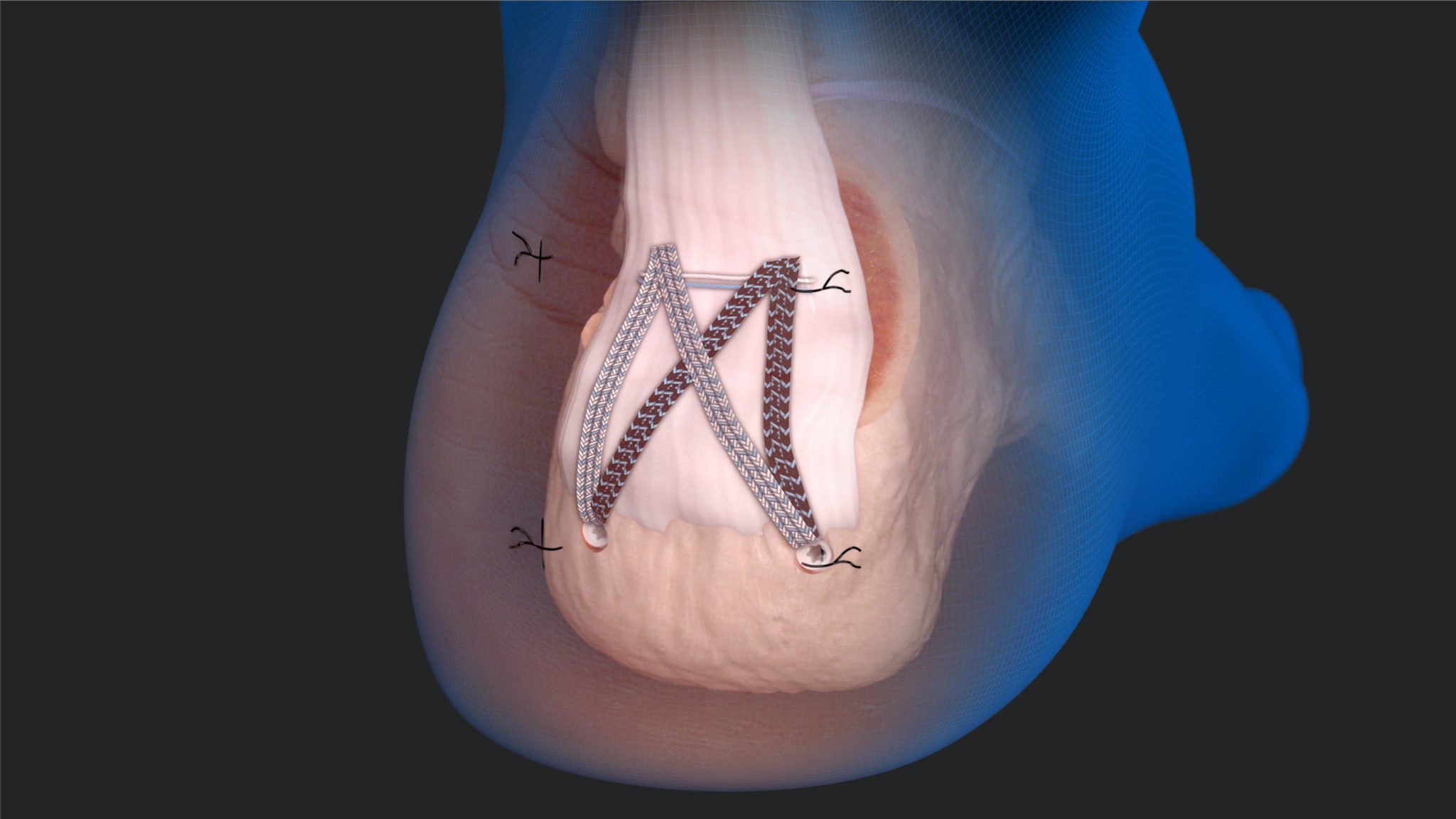 Aethrix Arthrex - MIS Achilles SpeedBridge™ Repair System Animation
