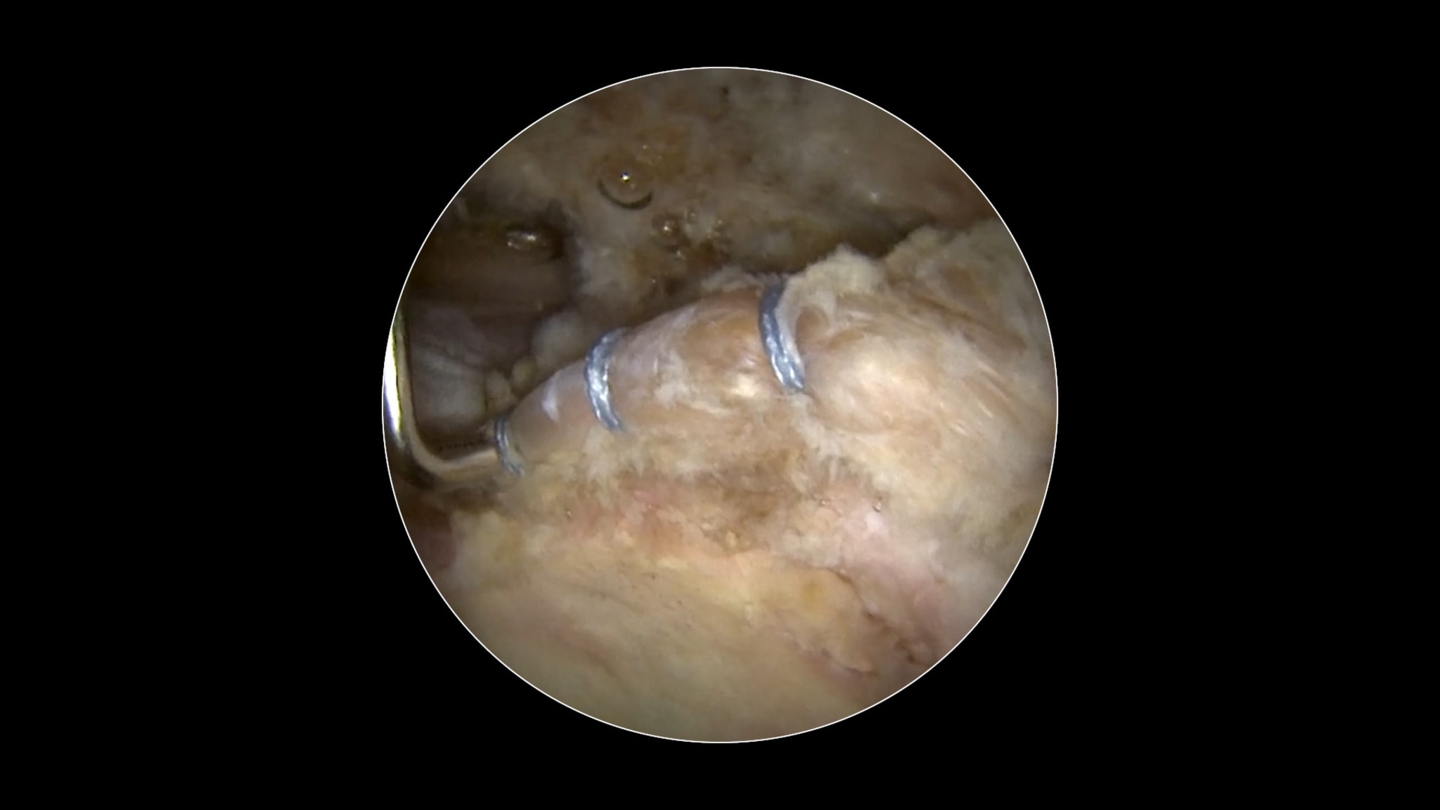 Labral Repair Using Knotless 1.8 Hip FiberTak® Anchors