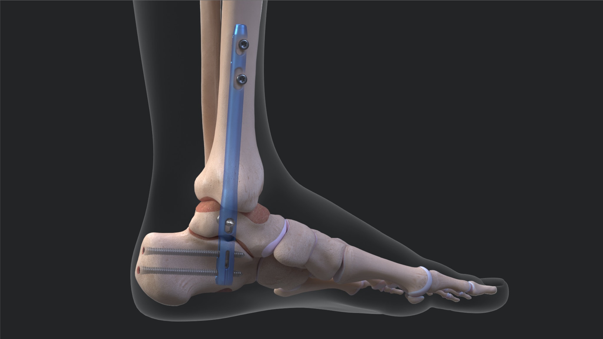 DualCompression Hindfoot Fusion Nail System