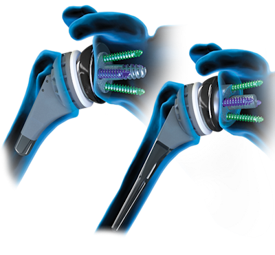 Arthrex - FxBridge™ Tuberosity Repair System: Reverse Total Shoulder ...