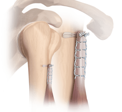 FiberTak<sup>®</sup> Biceps Tenodesis Technique