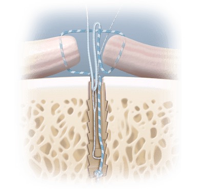 Técnica de reparación abierta SutureTak<sup>®</sup> sin nudos