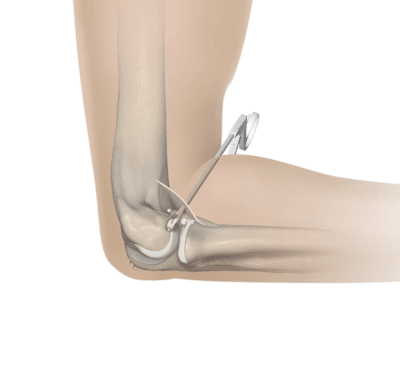 Entfernung von Osteophyten und freien Gelenkkörpern