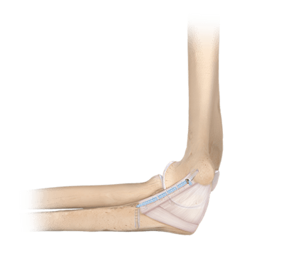 Sistema <em>Internal</em>Brace™ para LCC