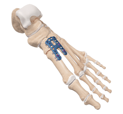 Lisfranc-Arthrodese