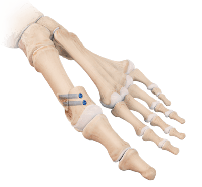 Osteotomia de Chevron