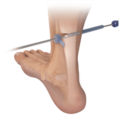 Endoscopic Gastrocnemius Recession