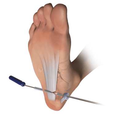 Endoskopische Plantarfaszienoperation