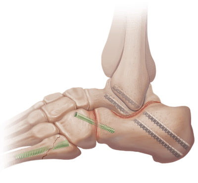 Subtalar Arthrodesis