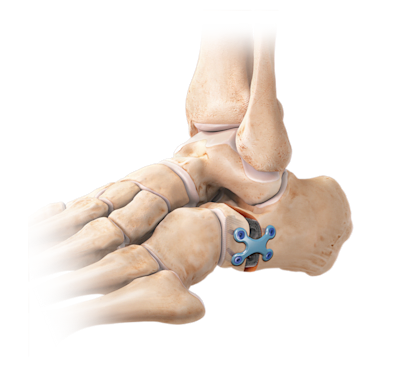 Alargamiento de la columna lateral (osteotomía de Evans)