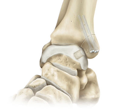 Osteotomía del maléolo medial