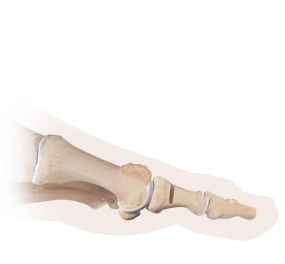 Moberg Osteotomy