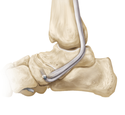 Transferência de tendão tibial posterior