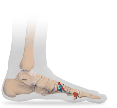 Osteotomía proximal del primer metatarsiano