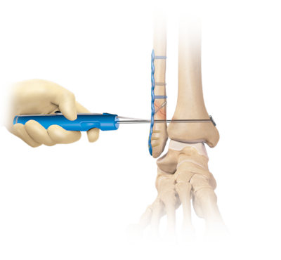 Reparación de sindesmosis