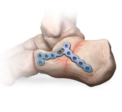 Calcaneal Fracture
 Management System