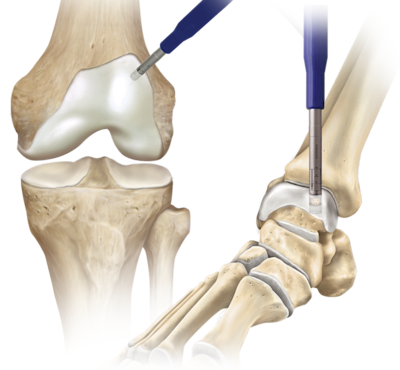 Cartilage Autograft