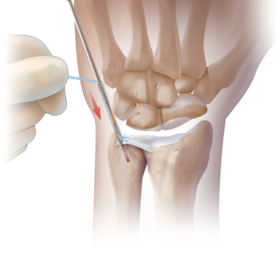 Reparación artroscópica sin nudos del CFCT usando PushLock<sup>®</sup>